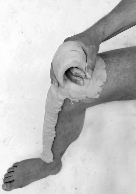 The black and white image shows a bent leg. From the ankle to the knee, the leg is covered with a plaster-like mass. A hand reaches into the plaster-like mass on the knee.